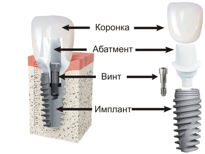 Что такое премил абатмент и для чего он используется в стоматологии